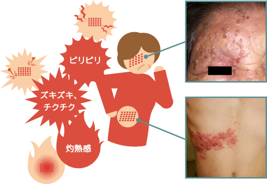 帯状疱疹はピリピリ、チクチクという痛みを伴い、写真のような水ぶくれなどが帯状に現れる